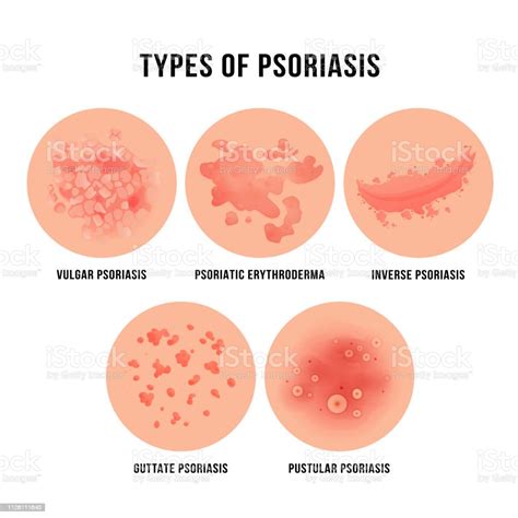 Psoriasis Skin Disease Types Of Derma Problem Stock Illustration