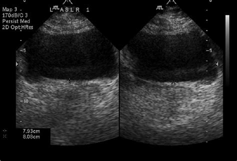 Typical Pelvis Ultrasound Demonstrating The Change In Pelvic Floor