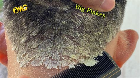 Dry Scalp Big Flakes Dandruff Scratching 3 Youtube