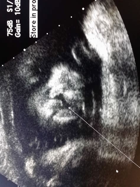 Fetal Ultrasound Cleft Lip