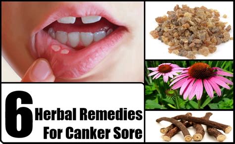 Top 6 Herbal Remedies For Canker Sore Natural Home Remedies And Supplements