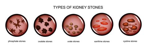 Kidney Stones Causes Symptoms And Treatment Options Yatharth Hospitals