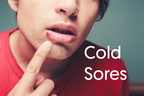 Cold Sores A Guide To Help Dental Aware Australia