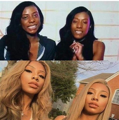 Clermont Twins Plastic Surgery Before And After Before And After