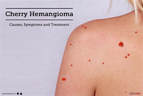 Cherry Hemangioma Causes Symptoms And Treatment By Dr Gunjan Shah