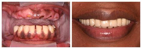 Implant Restorations Dental Designs Of Savannah