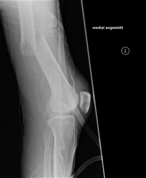 Pathological Fracture Of The Femoral Shaft Due To Lung Cancer