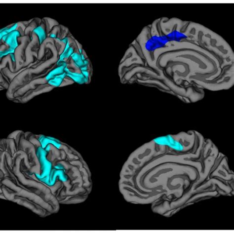 Pdf Brain Morphology In Children With Epilepsy And Adhd