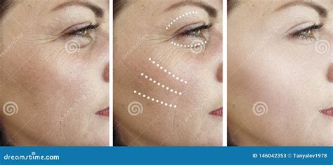 Woman Wrinkles Skin Before After Regeneration Treatment Removal