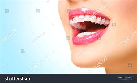 Braces Beautiful Woman Healthy Smile Close Up Closeup Ceramic Braces On Teeth Beautiful