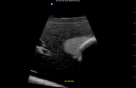 Thyroid Ultrasonography My Endo Consult
