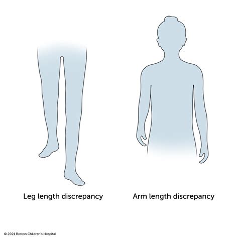 Limb Length Discrepancy Boston Childrens Hospital