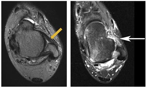 Centre montpelliérain de la cheville et du pied. Docteur Bruno Lévy | » Entorses et ligamentoplasties de la ...