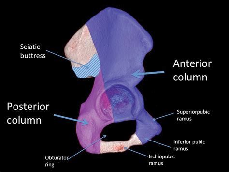 Acetabular Fractures A Stepwise Approach To Identification And