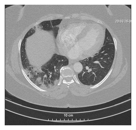 A Chest Computed Tomography Ct Scans Transverse Plane Of The