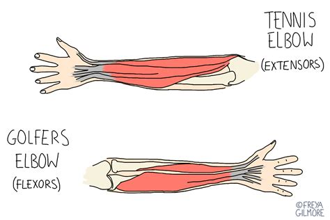 This is done by turning your palm face down, then flex the hand downwards. Tennis and Golfers elbow - The Osteopathic Health Centre