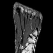 This is a 30 year old with swelling on the lateral aspect of foot with evidence of soft tissue lesion in relation to the lateral aspect of the talus which appears isointense to the muscles on t1 and t2. Abductor digiti minimi (foot) | Radiology Reference ...