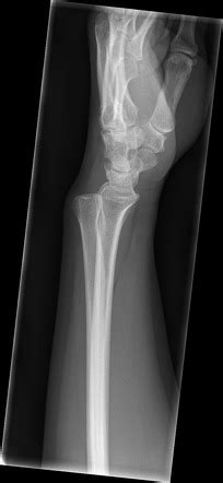Distal Radioulnar Joint Dislocation Radiology Case Radiopaedia Org