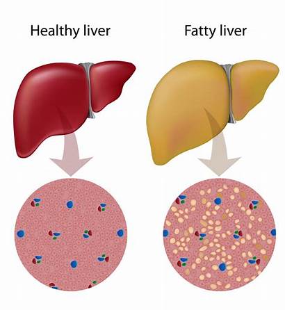 Liver Fatty Healthy Nafld Alcoholic Disease Alcohol