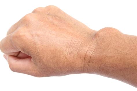 Ganglion cysts, also called bible cysts, are benign lumps on the hand. Effective natural treatments for ganglion cysts