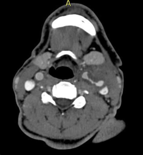 Carotid Arterial Pseudoaneurysm Radiology Case