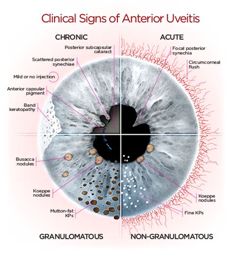 Uveitis Eye Facts Optometry School