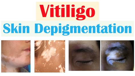 Vitiligo Skin Depigmentation Pathophysiology Signs And Symptoms