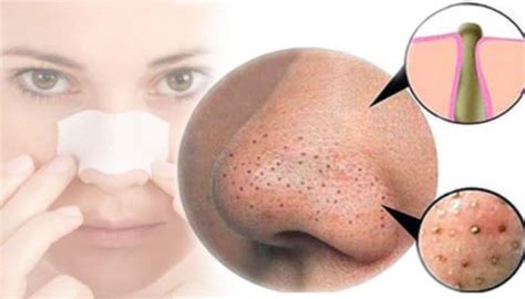 Depending on which part of the body is affected, common methods for removal include blackhead extraction tools or exfoliants. How to Get rid of Blackheads Fast