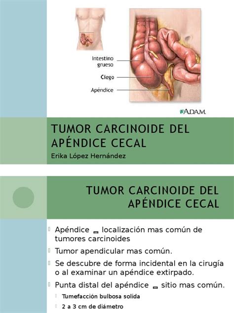 Carcinoid tumors may form in other organs of the body besides the lungs. Tumor Carcinoide Apéndice Cecal1 | Tinción | Biología Celular)