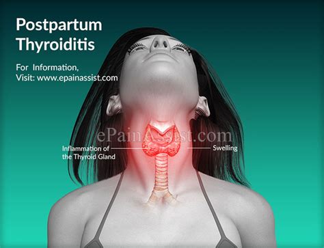 What Is Postpartum Thyroiditis Causes Symptoms Treatment