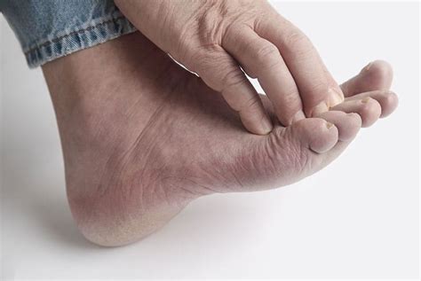 5 Easy Ways To Prevent Diabetic Foot And Its Complications