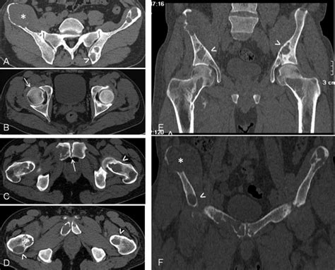 Pelvic Ct Axial And Coronal Views Illustrating Multiple Osteolytic