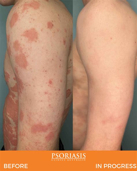 Psoriasis Before And After Treatment Psoriasis Clinics Australia