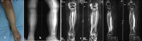 Paediatric Osteoarticular Tuberculosis A Review Journal Of Clinical