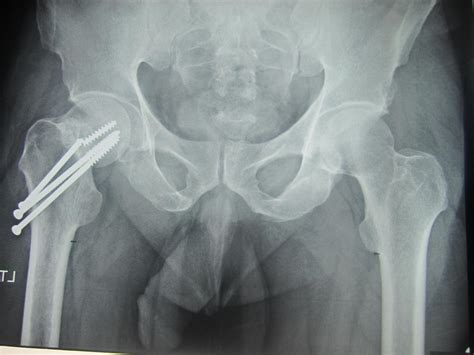 Subcapital Left Femoral Neck Fracture