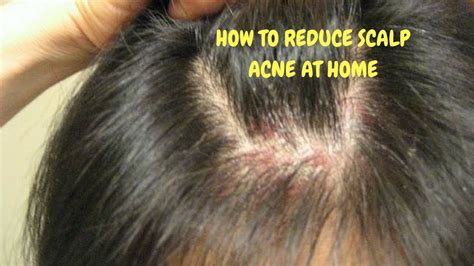 How To Reduce Scalp Acne At Home Youtube