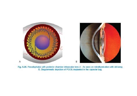 Pseudophakia With Posterior Chamber Intraocular Lens