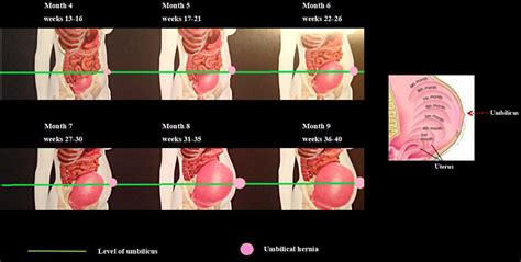 Return To Exercise After Umbilical Hernia Repair Exercise