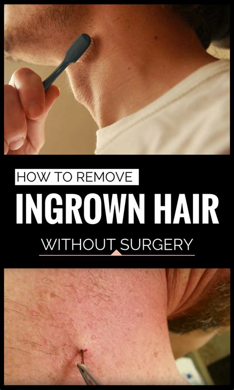 Ingrown hair removal videos are the newest extraction craze. How To Remove Ingrown Hair Without Surgery - 101BeautyTips ...