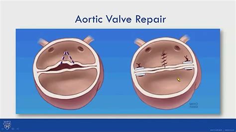 Valve Repair For Bicuspid Aortic Valve Related Aortic Regurgitation