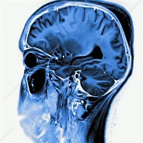 Brain Injury Mri Scan Sequence Stock Video Clip K0034509
