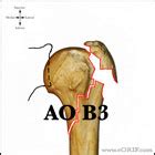 Proximal Humerus Fracture S42.209A 812.00 | eORIF
