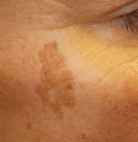Light Brown Spots On Skin