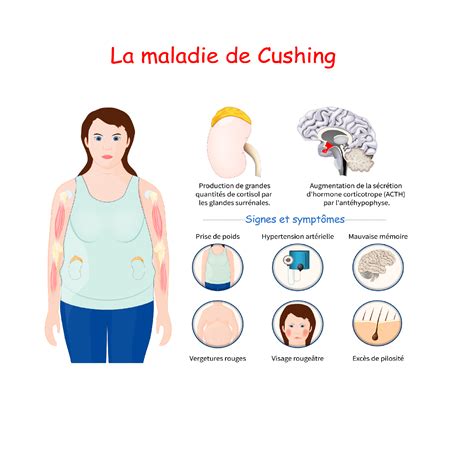 Syndrome De Cushing Causes Manifestations Et Traitements Information Hospitalière Lexique