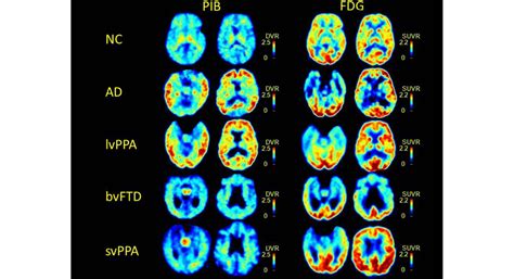 Amyloid imaging in the differential diagnosis of dementia: review and ...