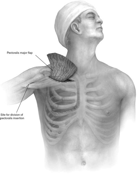 Technique Of Muscle Flap Harvest For Intrathoracic Use Operative