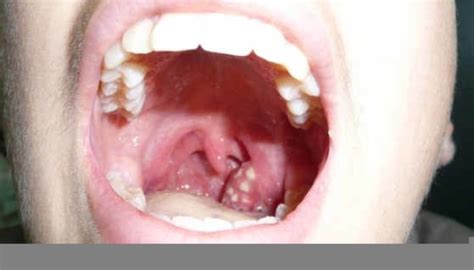 Inflamed Throat Free Images At Vector Clip Art Online