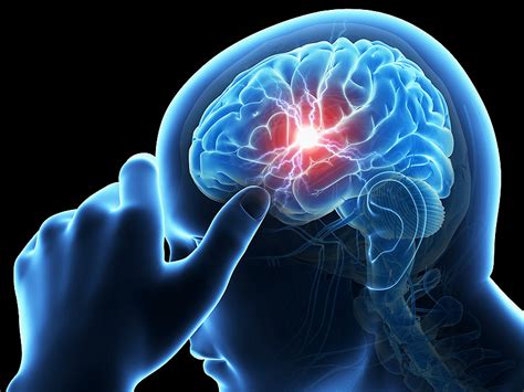 The Treatment And Prevention Of Brain Stroke