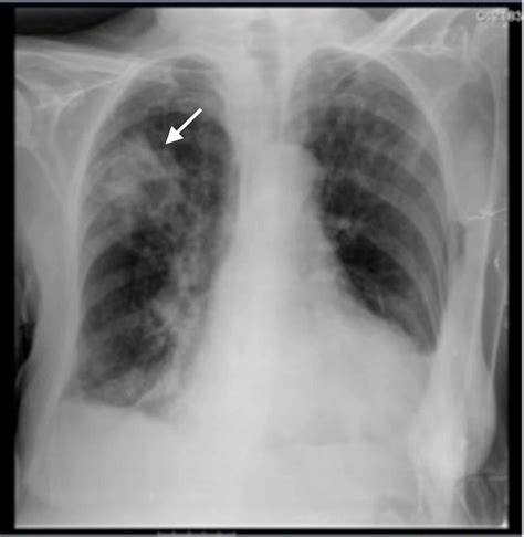 Cureus Invasive Pulmonary Aspergillosis In An Apparently