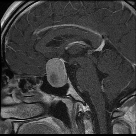Intracranial Tumors Summary Radiology Reference Article